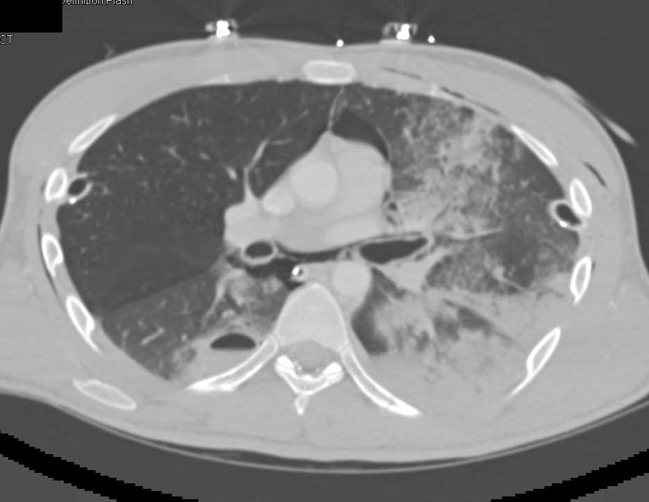 Pulmonary Hemorrhage Post Trauma - CTisus CT Scan