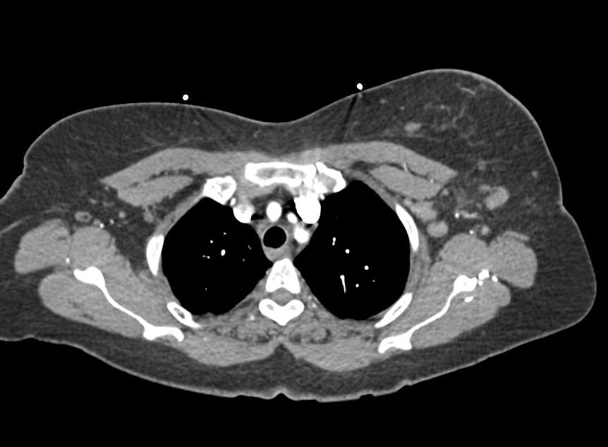 Left Breast Cancer with Axillary Adenopathy - CTisus CT Scan