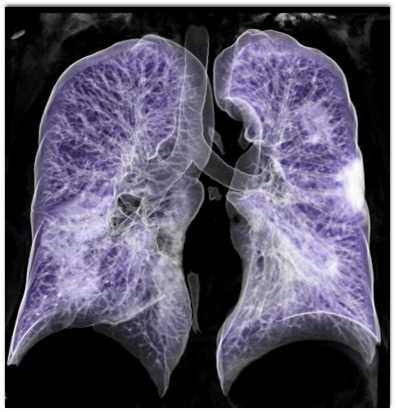 COVID-19 with Ground Glass Opacity (GGO) in 3D - CTisus CT Scan