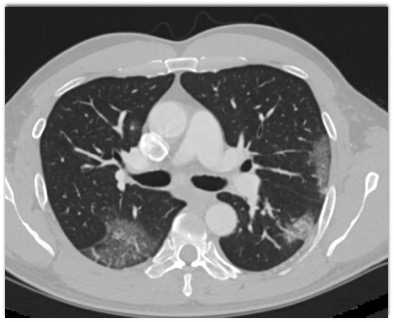 COVID-19 with Ground Glass Opacity (GGO) - CTisus CT Scan