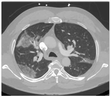 COVID-19 Pneumonia - CTisus CT Scan