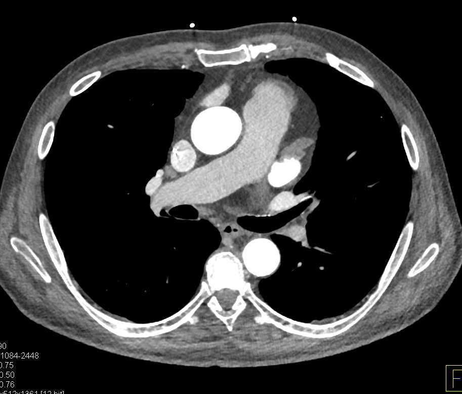 Pseudoclot in the Left Atrial Appendage - CTisus CT Scan