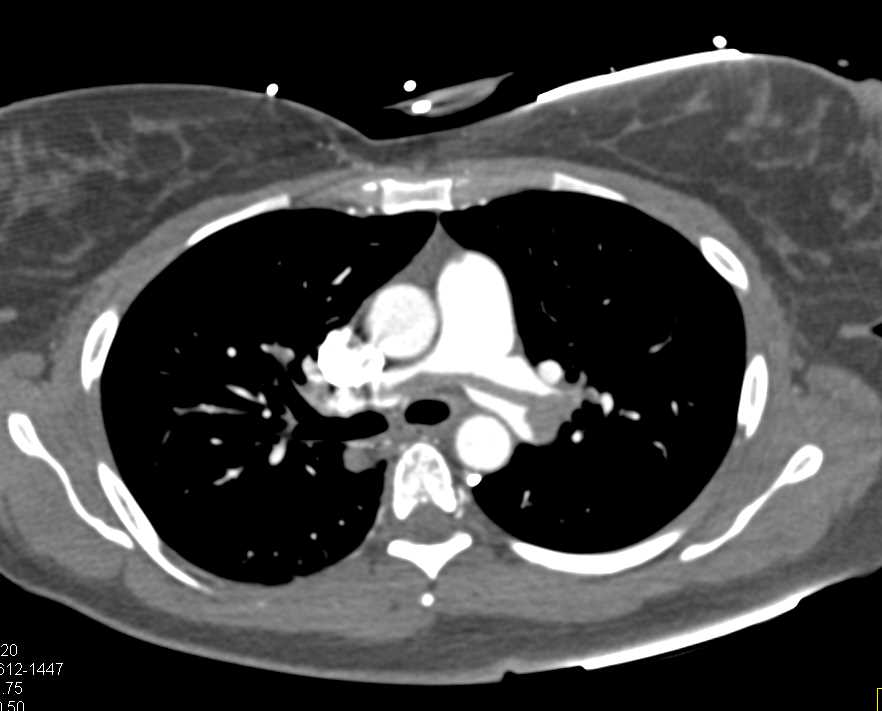 Saddle Pulmonary Embolism - CTisus CT Scan