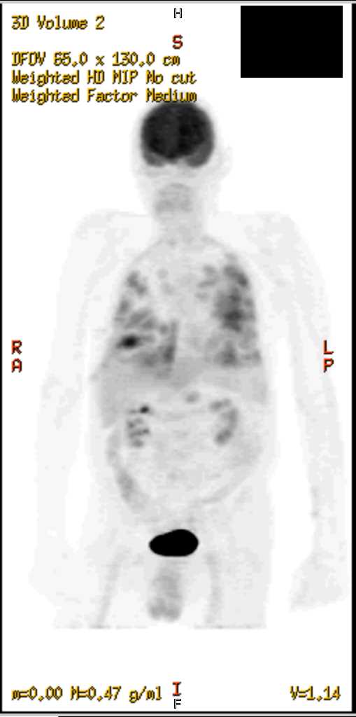 Septic Emboli on PET CT - CTisus CT Scan