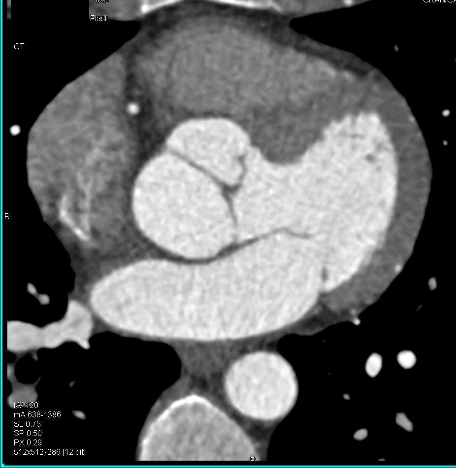 Dilated Aortic Root - CTisus CT Scan