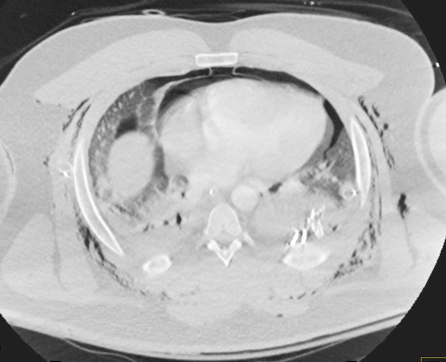 Pneumopericardium and Pneumothorax - CTisus CT Scan