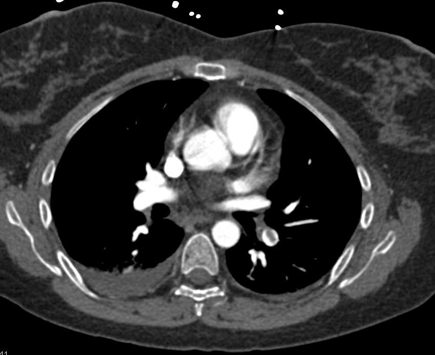 Carcinomatosis with Metastases to the Ovaries and Pulmonary Embolism (PE) - CTisus CT Scan