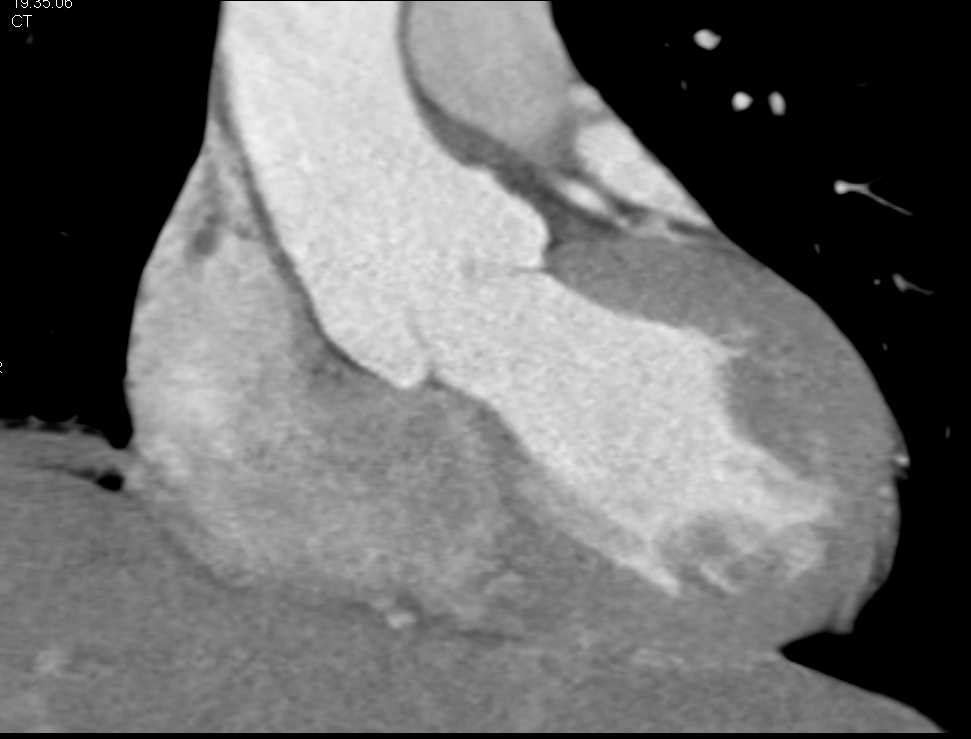 Incidental Right Pneumothorax on a Cardiac CTA - CTisus CT Scan