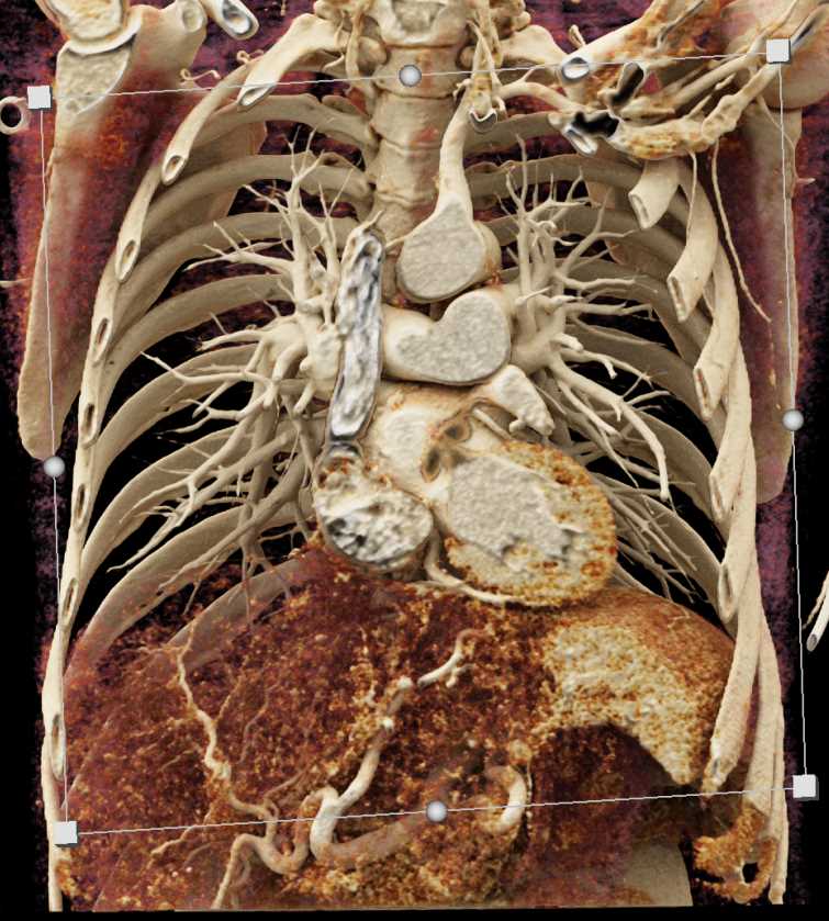 Pulmonary Arteriovenous Malformation (PAVM) Lingula with Cinematic Rendering - CTisus CT Scan