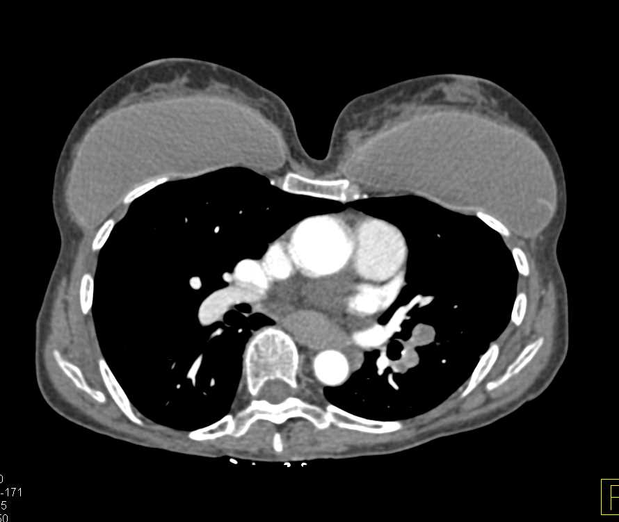 Left Sided Pulmonary Embolism - CTisus CT Scan