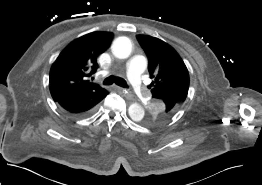Pulmonary Embolism in a Patient with Paget's Disease - CTisus CT Scan