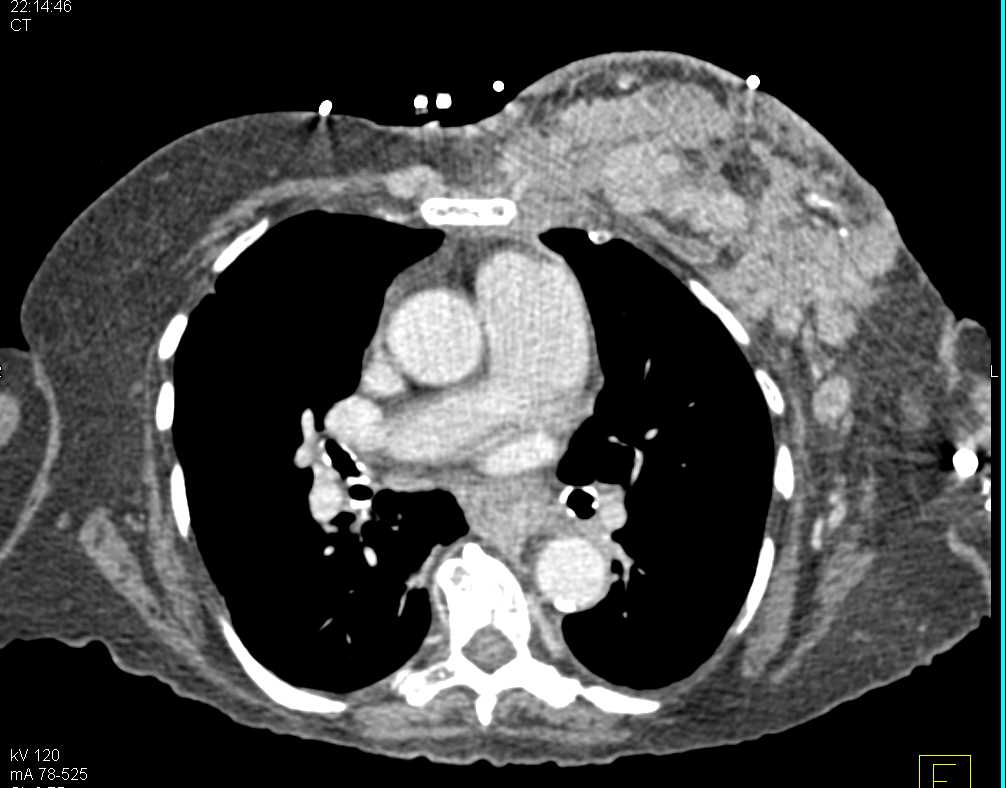 Infiltrating Left Breast Cancer with Axillary Adenopathy - CTisus CT Scan