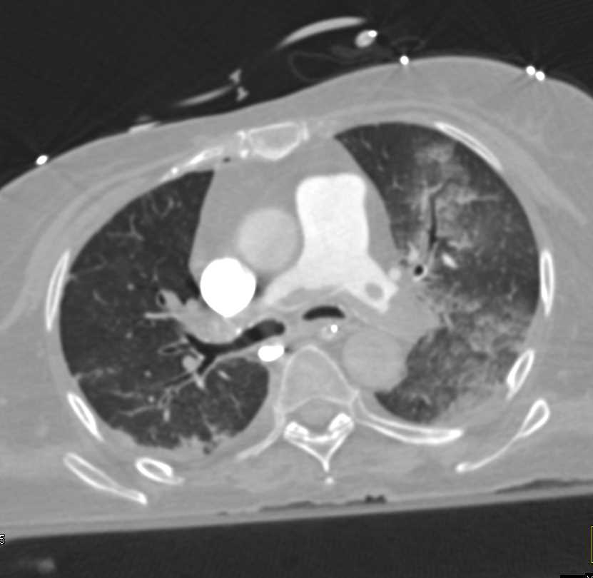 Saddle Pulmonary Embolism (PE) with Bright Adrenals due to Hypoperfusion - CTisus CT Scan