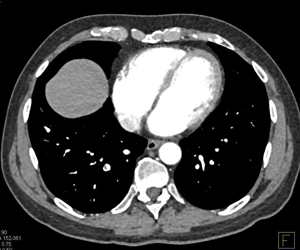 Pulmonary Embolism Right Lower Lung - CTisus CT Scan