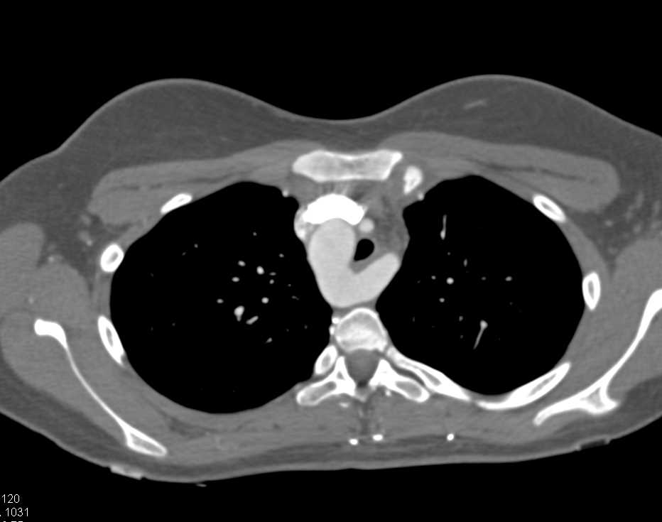 Right Aortic Arch - CTisus CT Scan