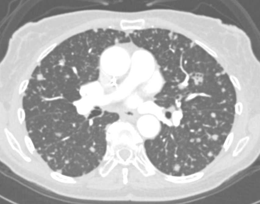 Miliary Tuberculosis (TB) - CTisus CT Scan