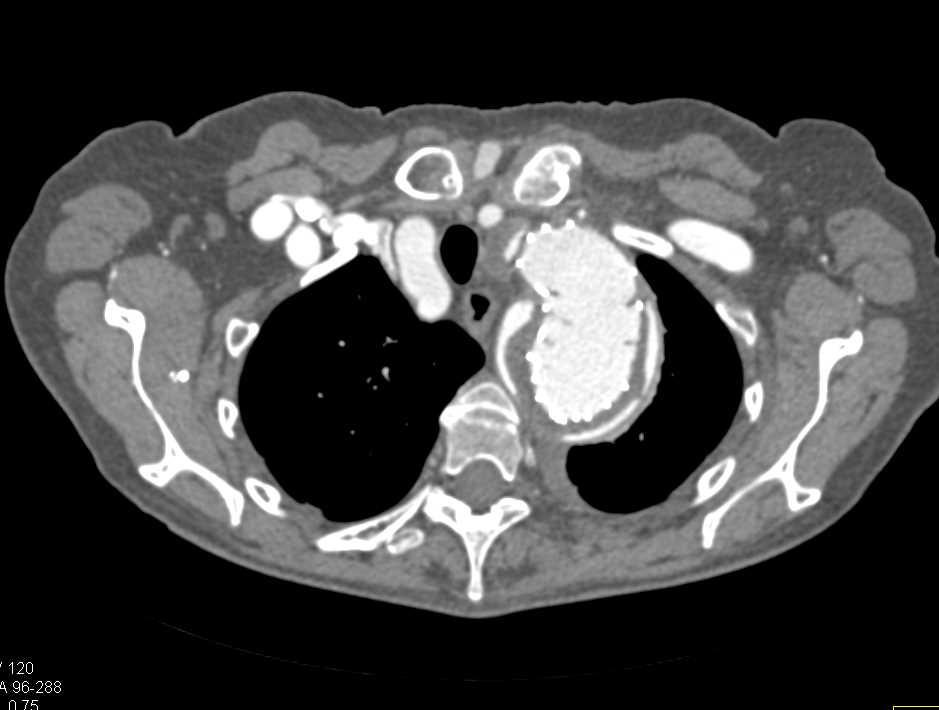 Endovascular Stent with Endoleak - CTisus CT Scan