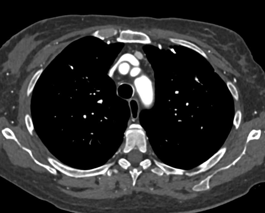 1cm Ectopic Parathyroid Adenoma - CTisus CT Scan