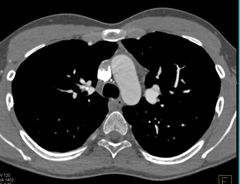 AV Shunting Chest Wall - CTisus CT Scan