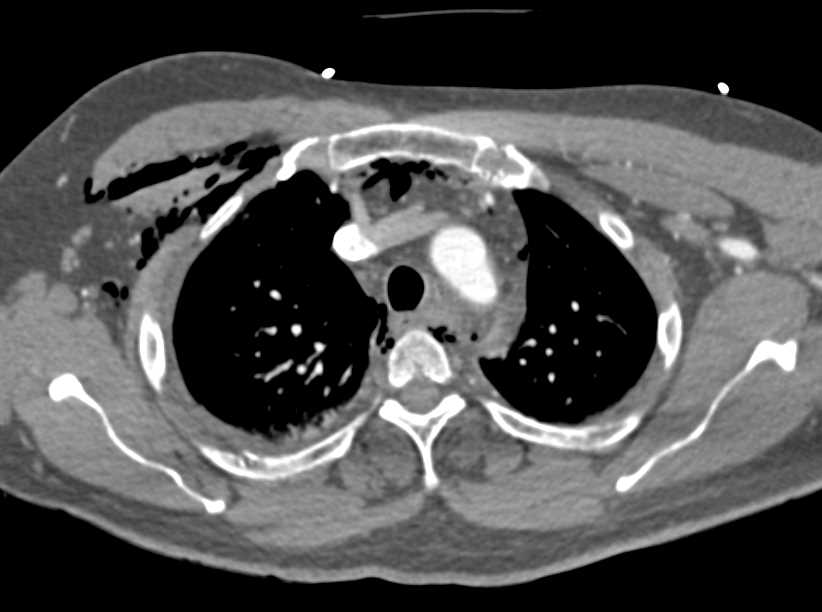 Thoracic Trauma - CTisus CT Scan