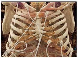 COVID-19 Pneumonia with Cinematic Rendering - CTisus CT Scan