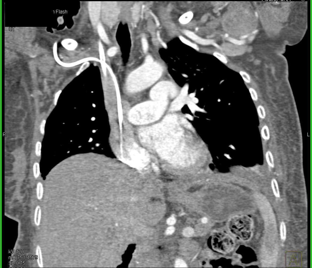 Superior Vena Cava (SVC) Clot and Dilated Azygous Vein - CTisus CT Scan