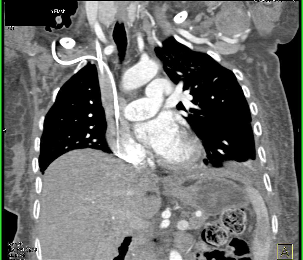 SVC Clot and Dilated Azygous Vein - CTisus CT Scan