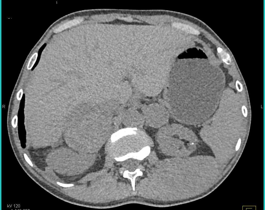 Metastatic Melanoma to Chest, Adrenals and Muscle - CTisus CT Scan