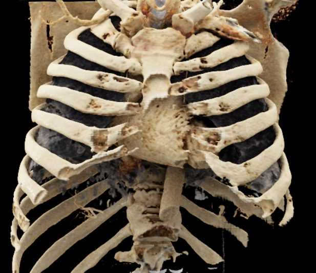 COVID-19 Pneumonia in 3D - CTisus CT Scan