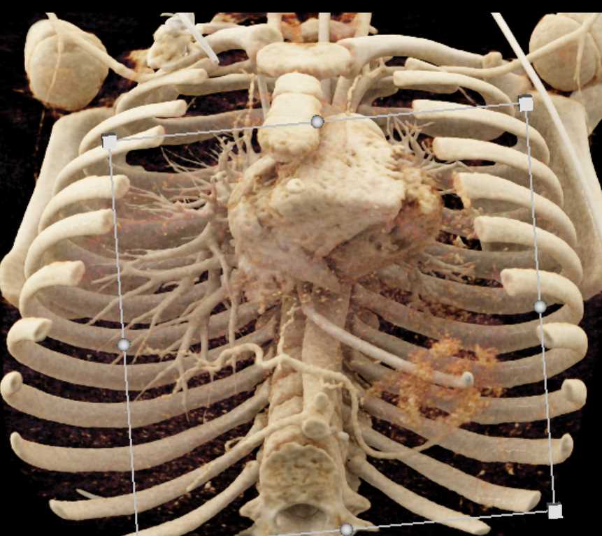 Large Left Pulmonary Embolism - CTisus CT Scan