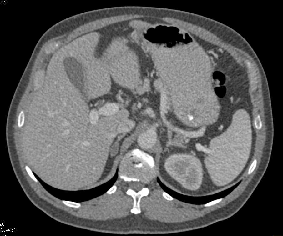 Thymic Cyst and Adrenal Adenomas - CTisus CT Scan