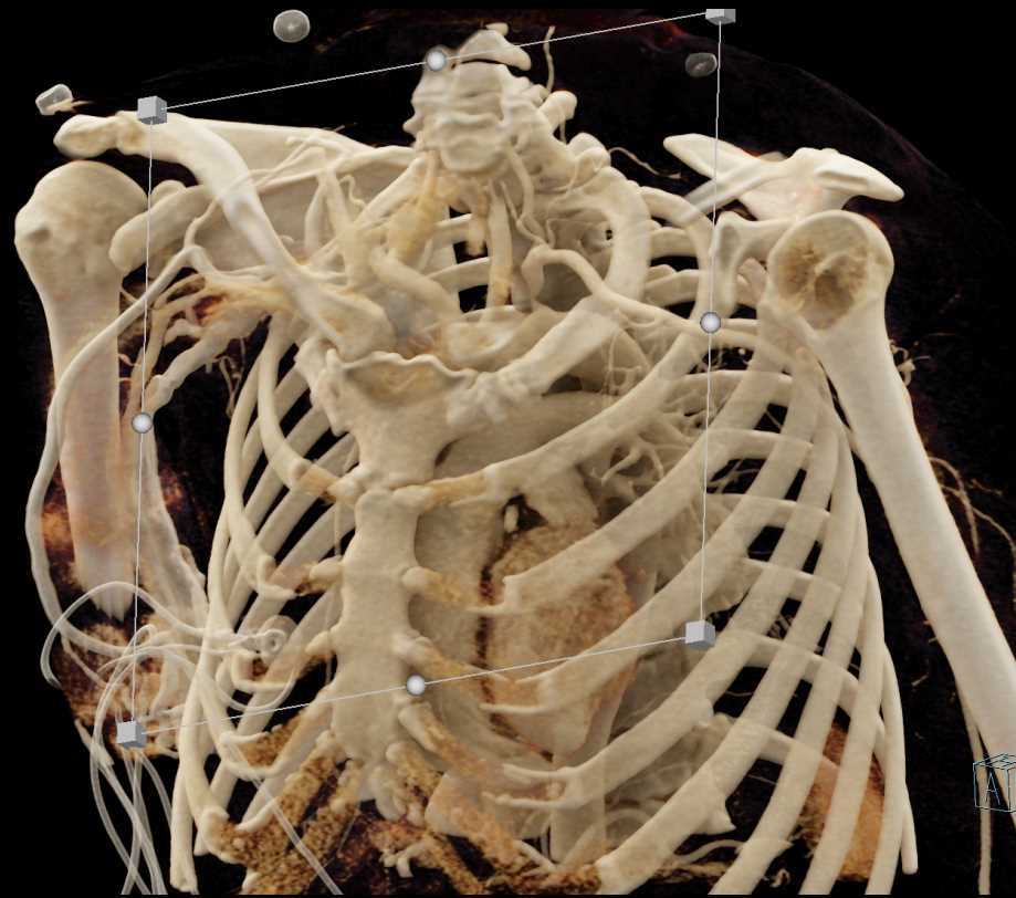 Takayasu Aortitis Involves the Left Subclavian Artery - CTisus CT Scan