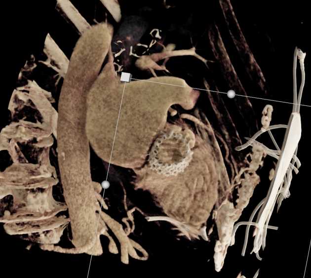 Post Transcatheter Aortic Valve Replacement (TAVR) Changes Aortic Valve with Cinematic Rendering (CR) - CTisus CT Scan