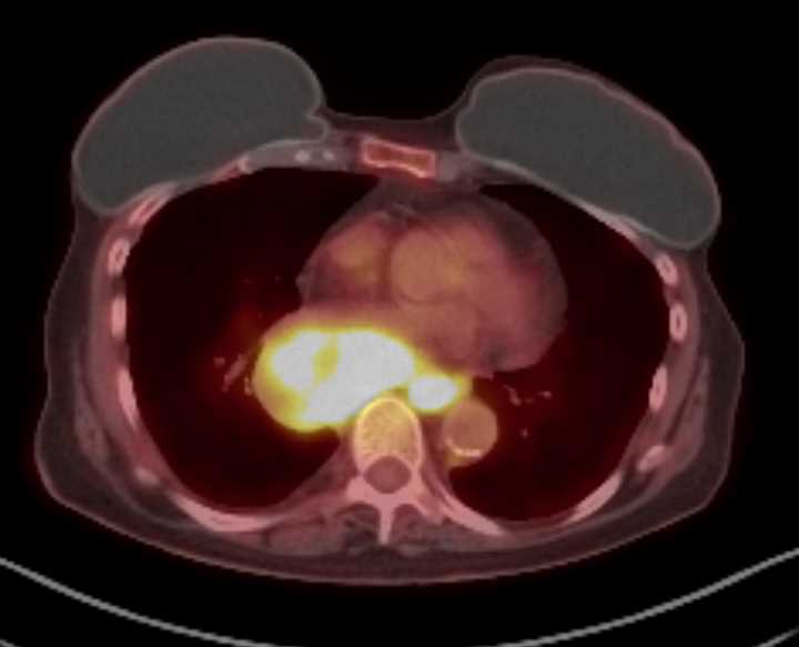 Extensive Adenopathy Consistent with Malignancy with Positive PET - CTisus CT Scan