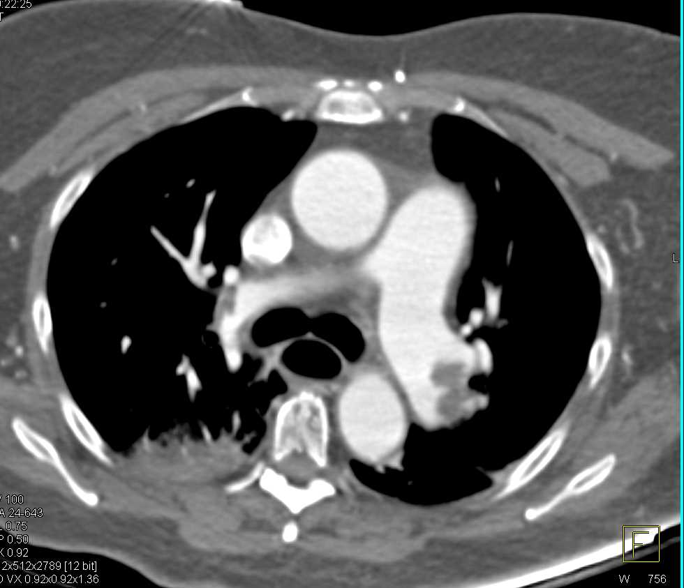Pulmonary Emboli and Infarction - CTisus CT Scan