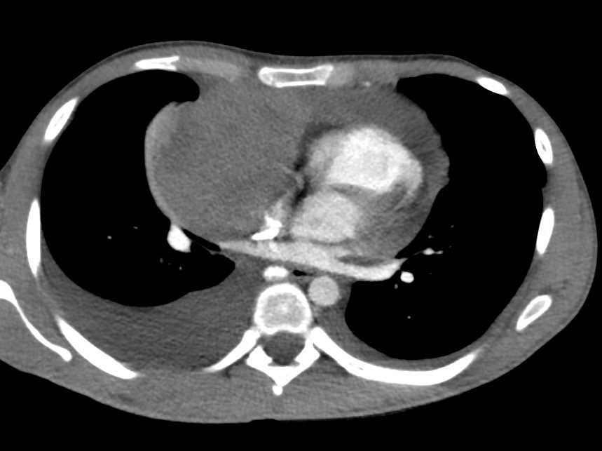 Lymphoma - CTisus CT Scan