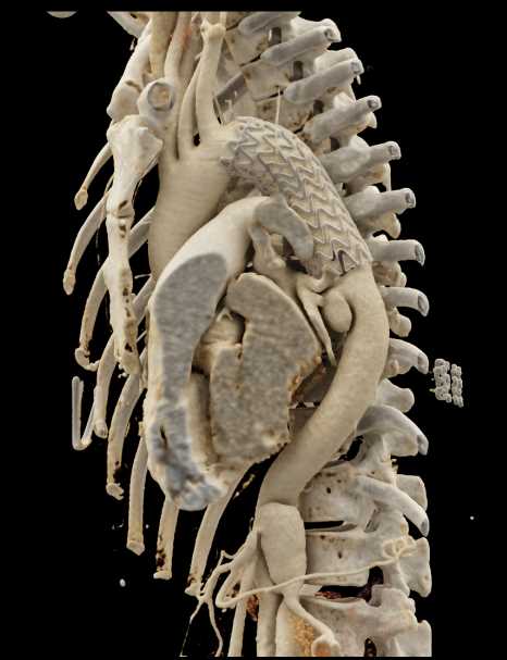 Stent Repair Descending Thoracic Aorta - CTisus CT Scan