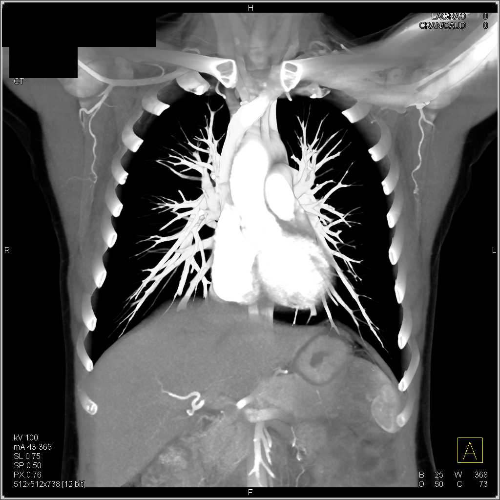 Branch Vessels off the Arch - CTisus CT Scan