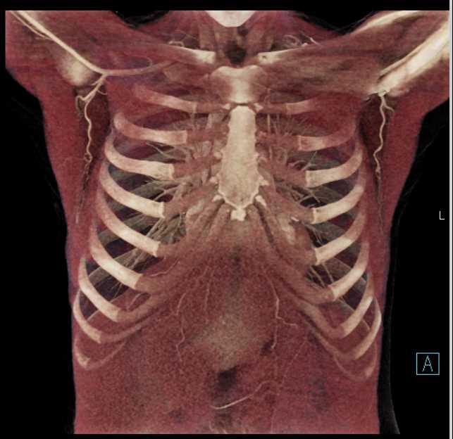 Normal Chest CT Anatomy - CTisus CT Scan