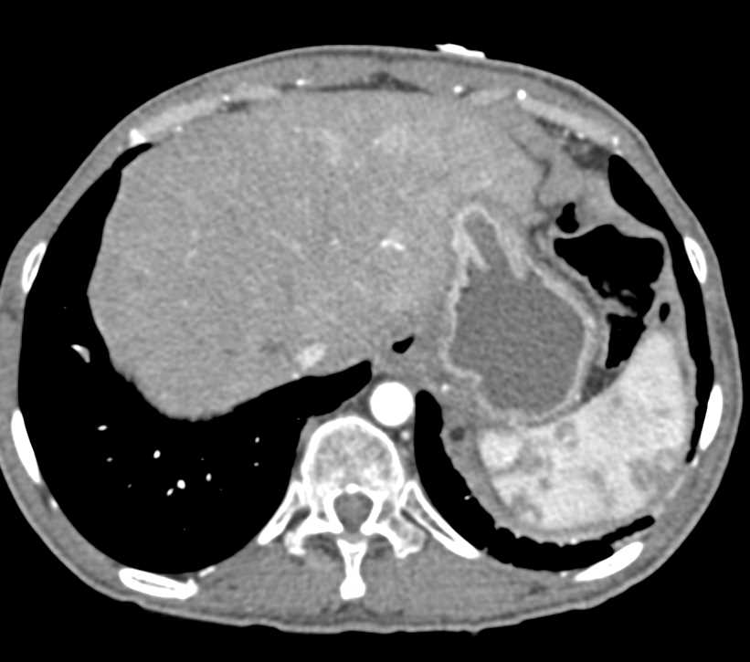 B Cell Lymphoma - CTisus CT Scan