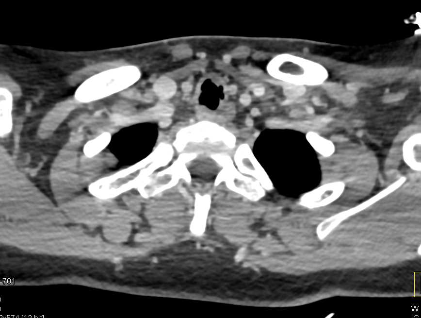 Tracheal Stenosis with Ulceration - CTisus CT Scan