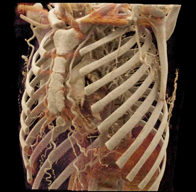 Internal Mammary Arteries - CTisus CT Scan