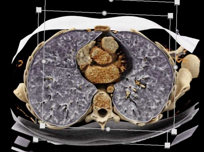 Cinematic Rendering of the Lungs - CTisus CT Scan