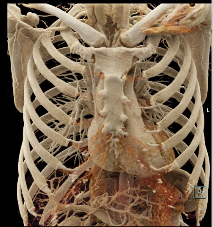 Cinematic Rendering of Normal Chest Anatomy - CTisus CT Scan