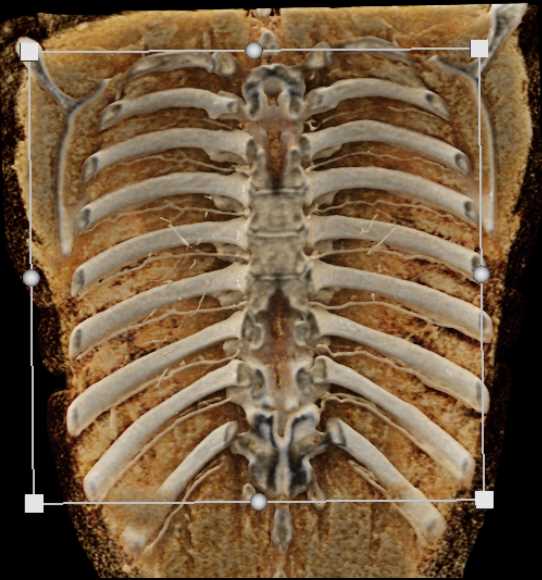 Cinematic Rendering of Normal Chest Anatomy - CTisus CT Scan