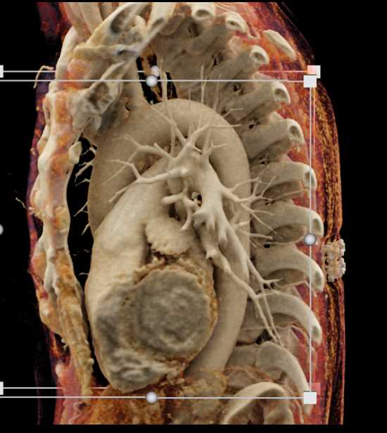 Cinematic Rendering of Normal Chest Anatomy - CTisus CT Scan