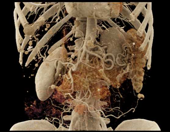 Cinematic Rendering of Normal Chest Anatomy - CTisus CT Scan