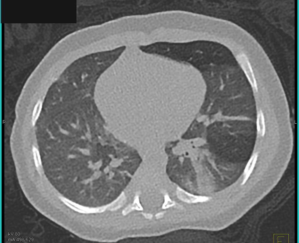 Air Trapping in the left Upper Lobe - CTisus CT Scan
