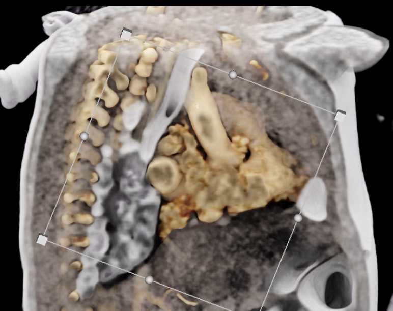 3D Vascular Mapping for Pediatric Vascular Display with Nasogastric Tube (NG Tube) - CTisus CT Scan