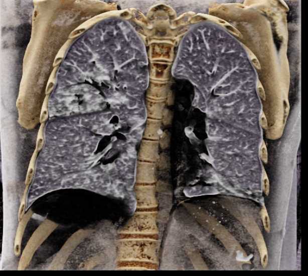 Cavitary Lesions due to Septic Emboli and IVDA - CTisus CT Scan